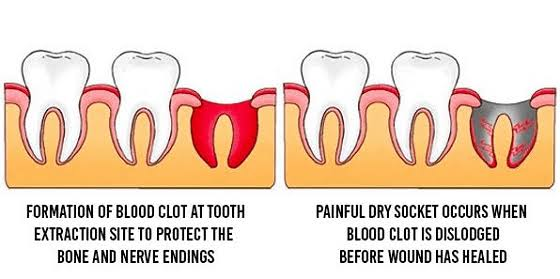 Dry Socket Symptoms and Treatment: A Dentist Reveals What's Really Happening After Your Extraction| HEH 2 image 5